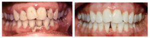 periodontal-disease-before-and-after-treatment