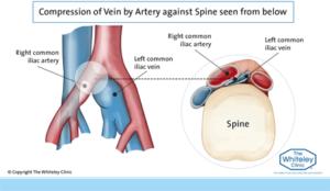 Iliac Vein Compression